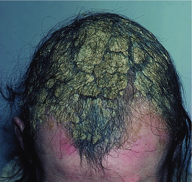 Psoriasis Plastic Surgery Key