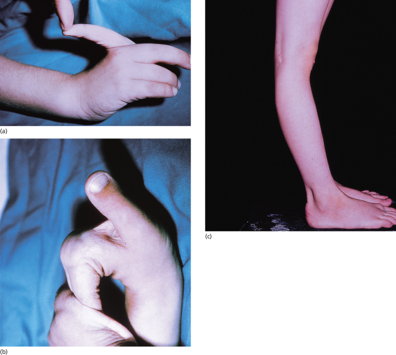 142 EhlersDanlos Syndromes Plastic Surgery Key