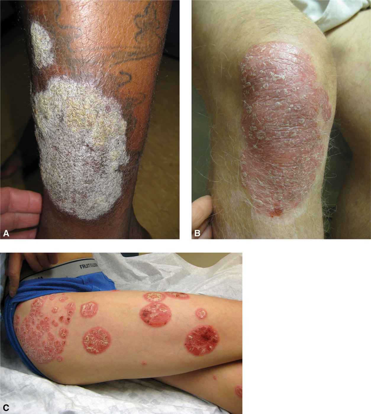 Papulosquamous Disorders Plastic Surgery Key