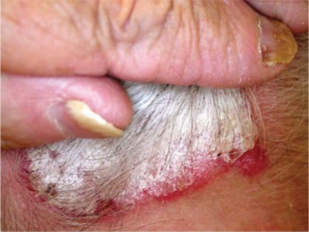 Papulosquamous Disorders Plastic Surgery Key