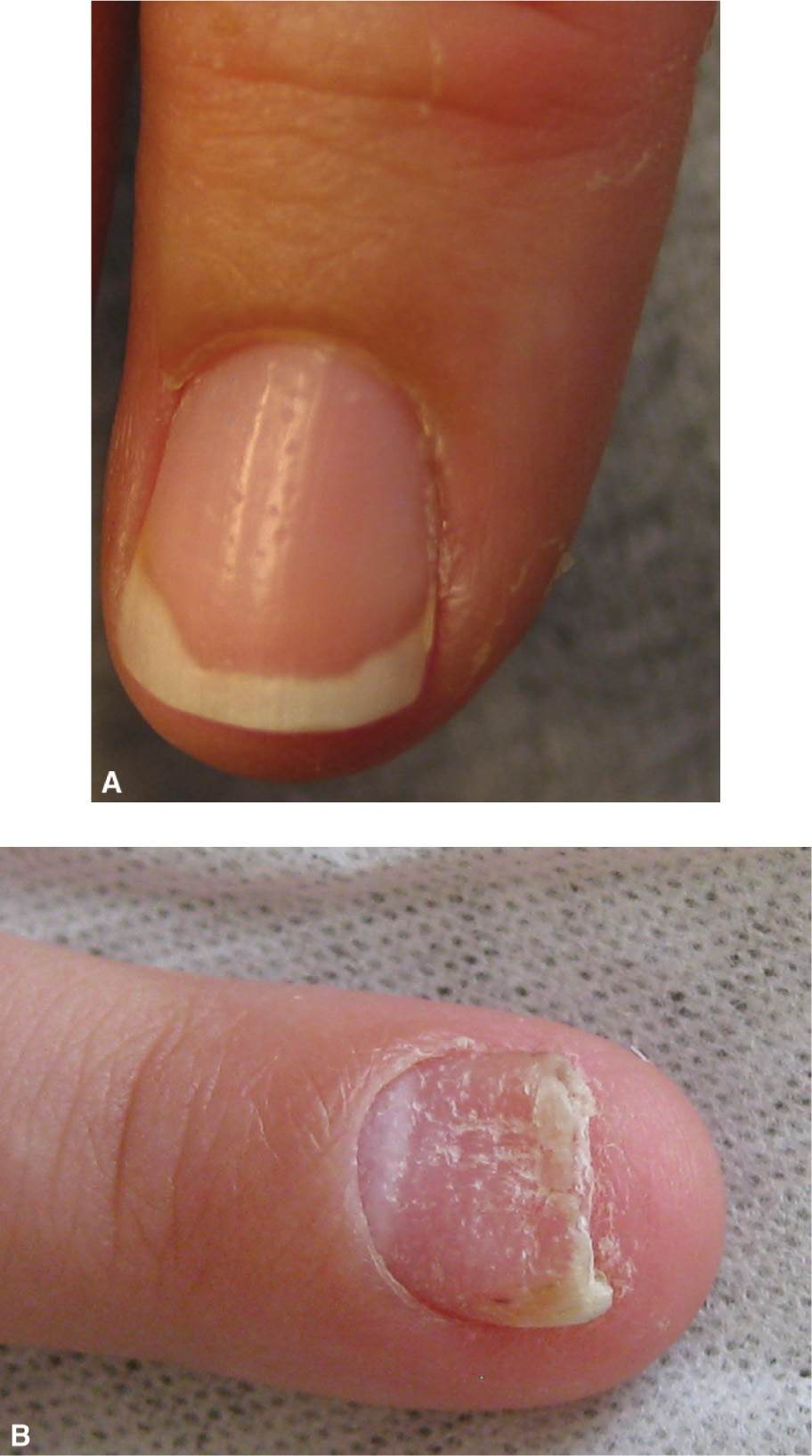 Papulosquamous Disorders Plastic Surgery Key