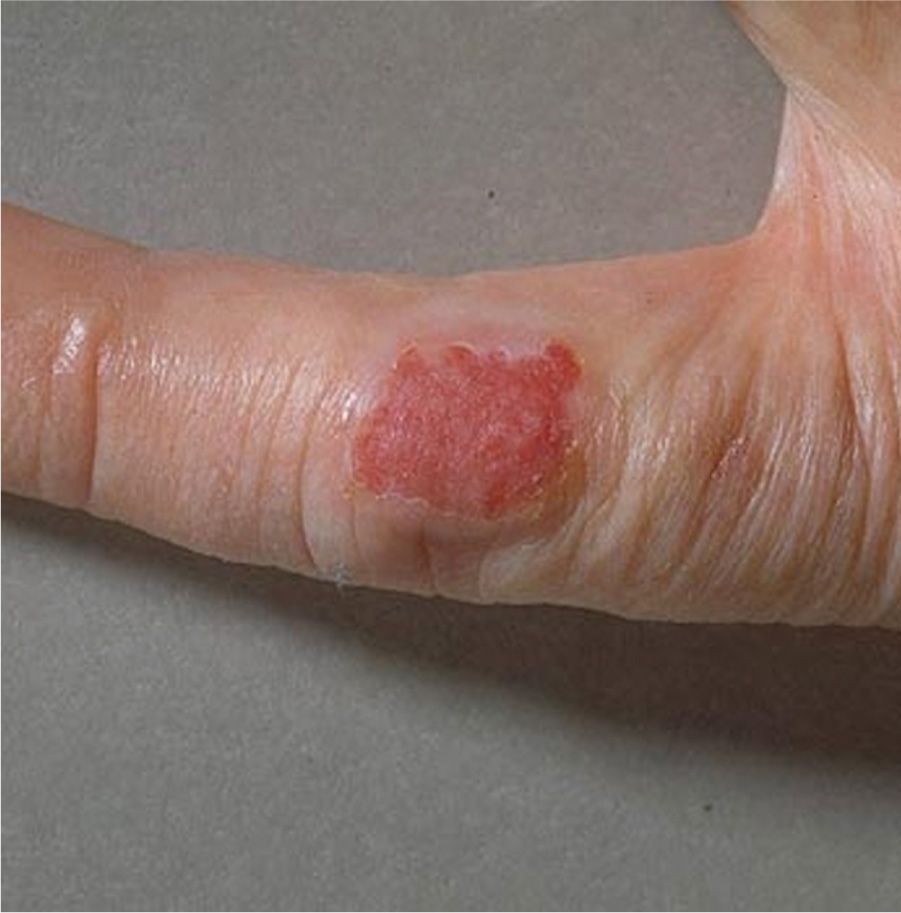 Melanoma Skin Cancer Pictures On Hands