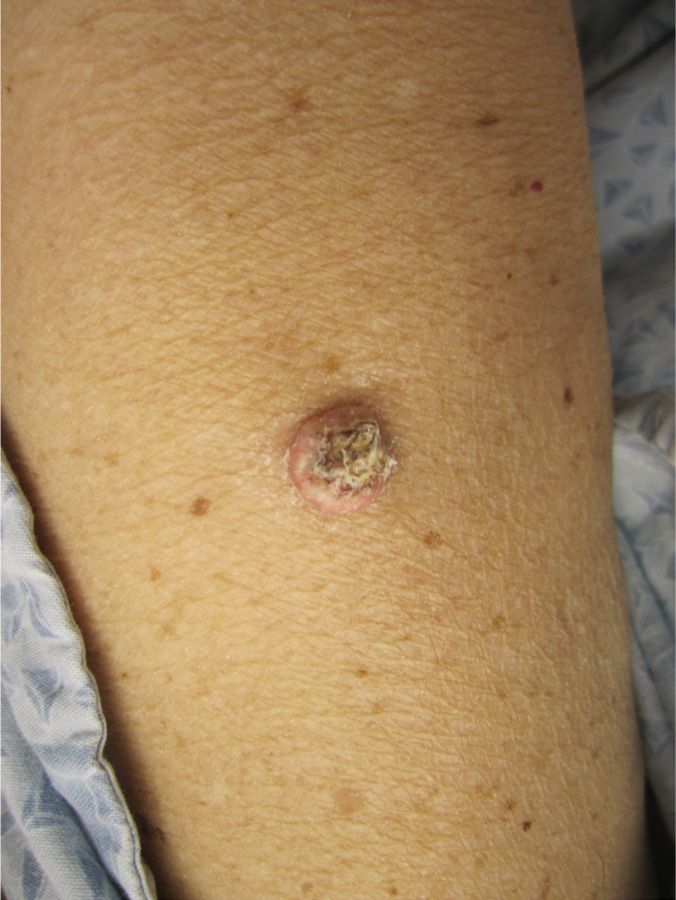 Skin Cancer Spots On Arm