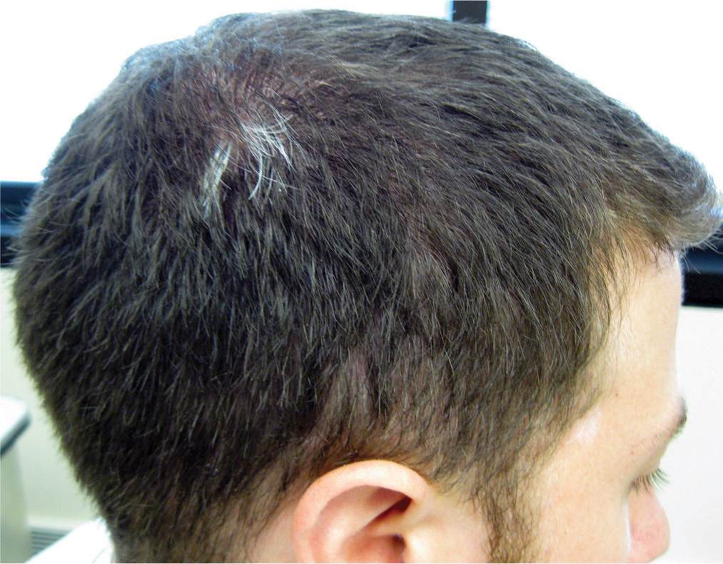 Pigmentation and LightRelated Dermatoses Plastic Surgery Key