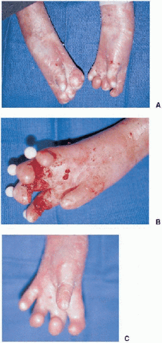 Epidermolysis Bullosa | Plastic Surgery Key