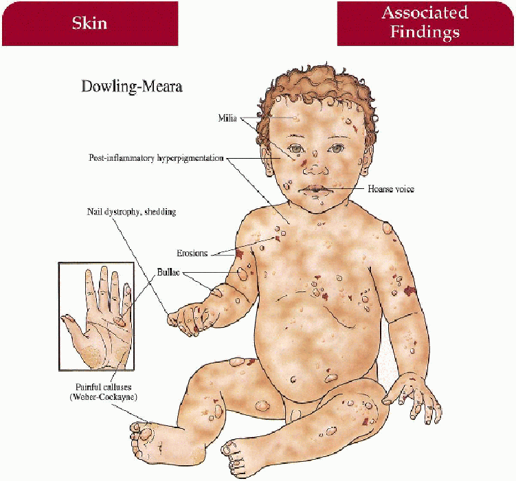 Epidermolysis Bullosa Plastic Surgery Key