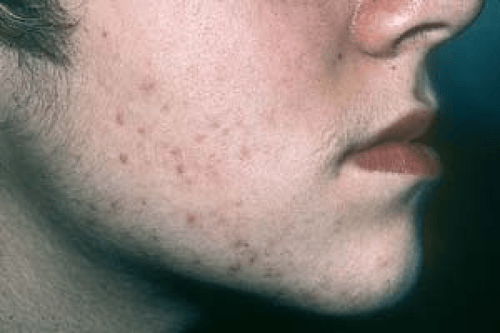 Hirsutism Plastic Surgery Key