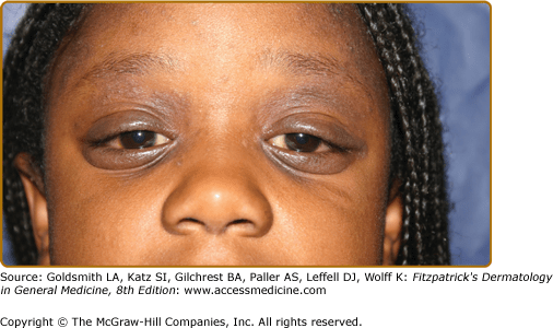 Atopic Dermatitis (Atopic Eczema) Plastic Surgery Key