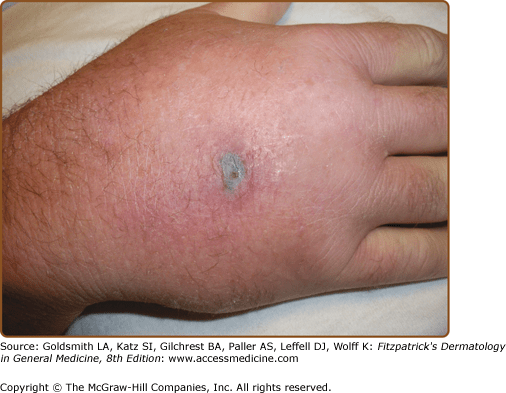 Skin Disease in Acute and Chronic Immunosuppression Plastic Surgery Key