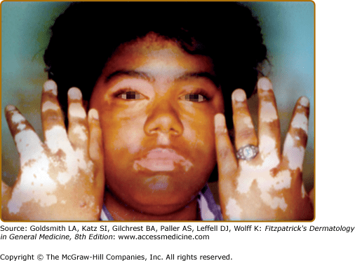 Vitiligo Plastic Surgery Key