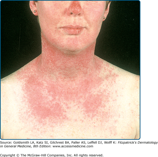 Abnormal Responses to Ultraviolet Radiation Idiopathic, Probably