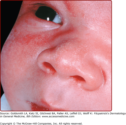 Neonatal, Pediatric, and Adolescent Dermatology Plastic Surgery Key