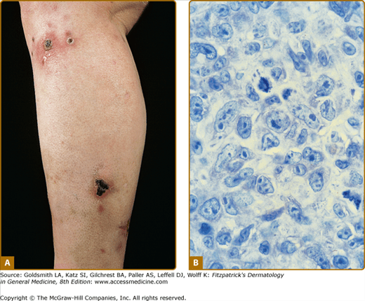 Cutaneous Lymphoma Plastic Surgery Key