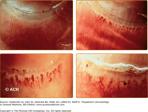 Raynaud Phenomenon Plastic Surgery Key