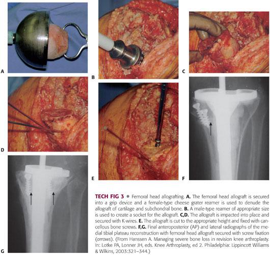 Total Knee Arthroplasty with Tibial Bone Loss Bone