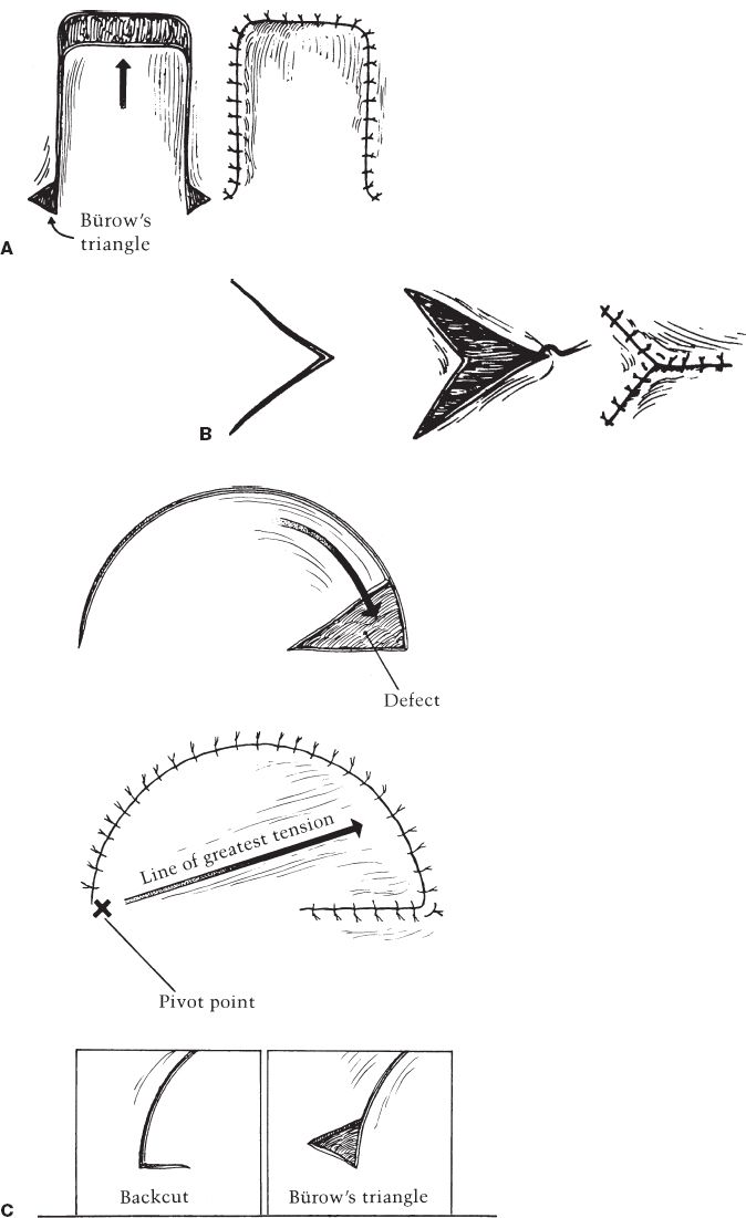 Flaps Plastic Surgery Key