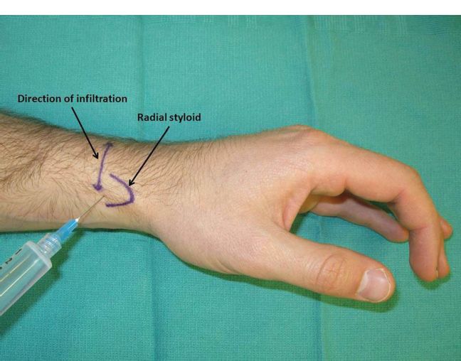 Thumb Nerve Block Technique