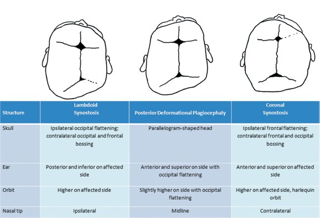 Facial Clefts and Craniosynostosis: Principles and Management
