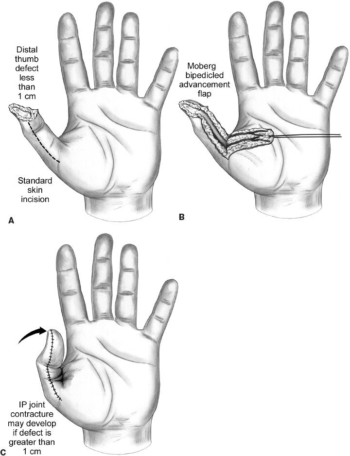 Thumb Reconstruction Plastic Surgery Key
