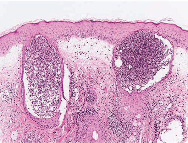 Inflammatory Diseases of Hair Follicles, Sweat Glands, and Cartilage