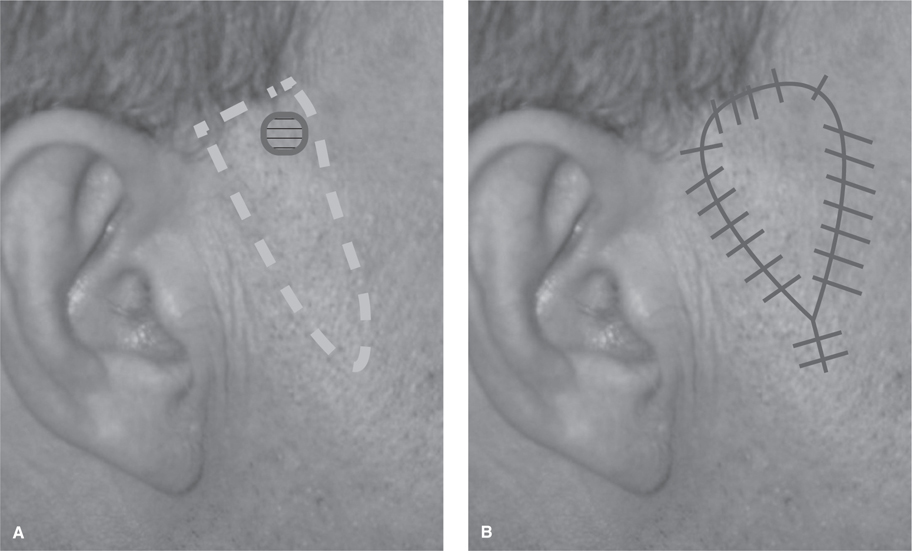 Local and Regional Flaps for Head and Neck Reconstruction Plastic