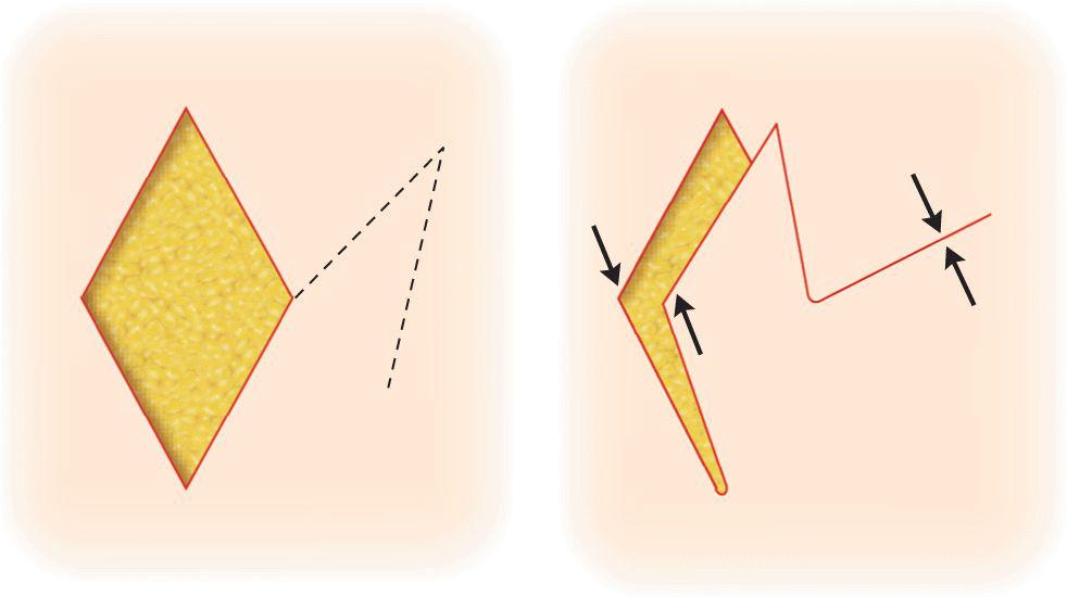 Transposition Flaps Plastic Surgery Key