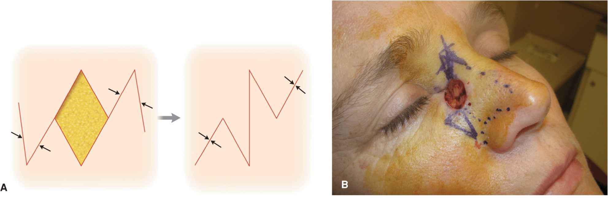 Transposition Flaps Plastic Surgery Key