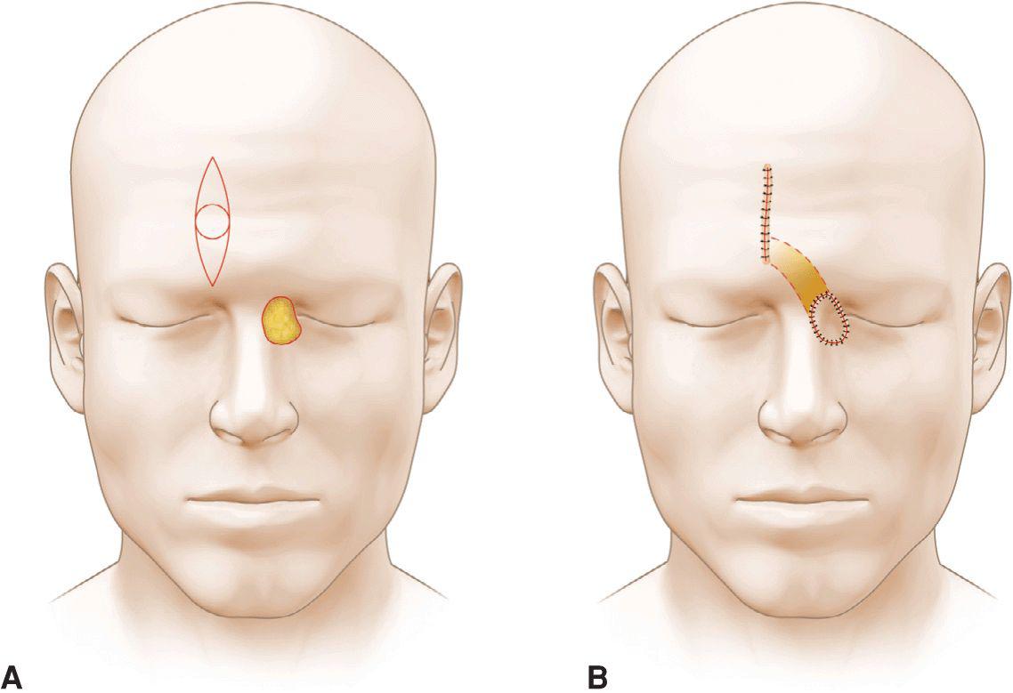 Island Pedicle Flaps | Plastic Surgery Key