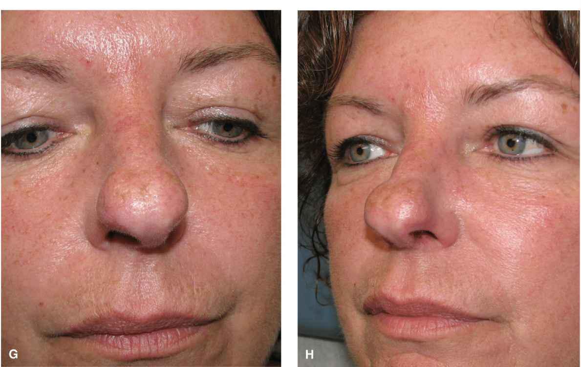 Nose Plastic Surgery Key