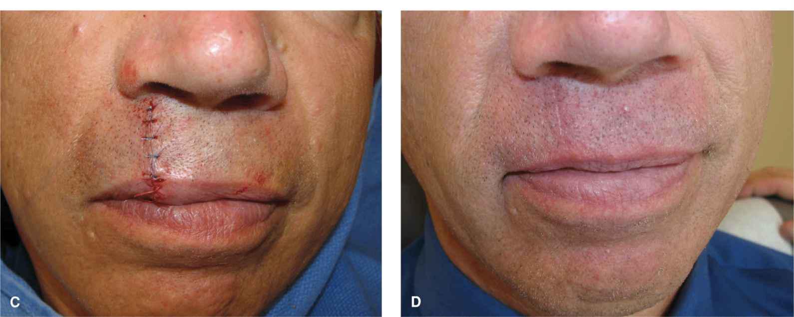 Lip Plastic Surgery Key