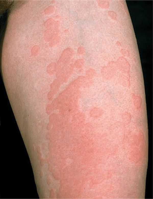 14 THE SKIN IN IMMUNE, AUTOIMMUNE, AND RHEUMATIC DISORDERS Plastic