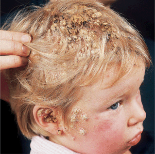 26 Fungal Infections Of The Skin, Hair, And Nails | Plastic Surgery Key