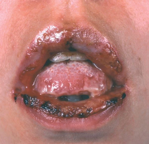 33 DISORDERS OF THE MOUTH Plastic Surgery Key