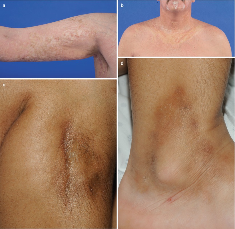 Diagnosis, Staging, and Treatment of Chronic GraftVersus