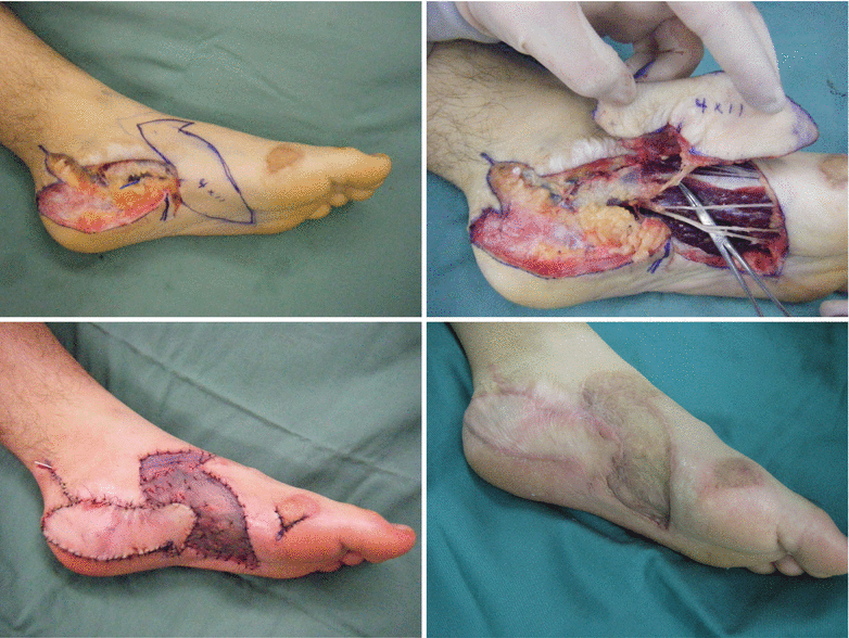 Reconstruction of Calcaneal Region/Lateral Plantar Region