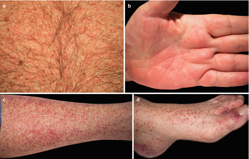 Grading And Treatment Of Acute Graft Versus Host Disease Plastic Surgery Key