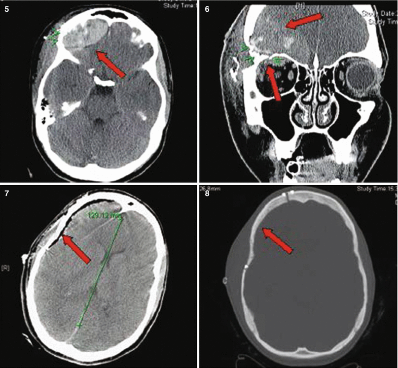 Gunshot Injuries to the Head | Plastic Surgery Key