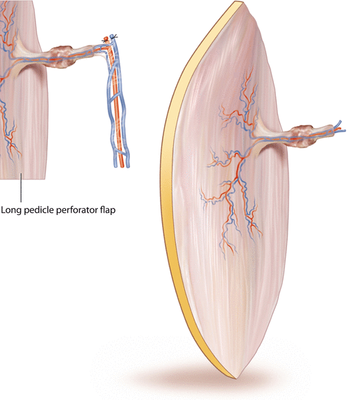 Soleus Perforator Flap Plastic Surgery Key