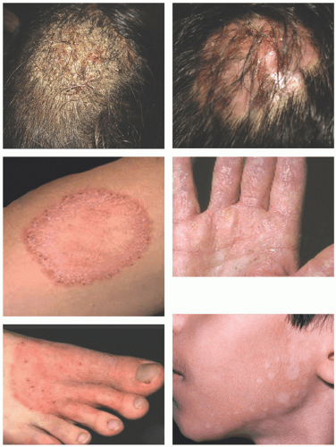 Fungal And Algal Cutaneous Infections Plastic Surgery Key
