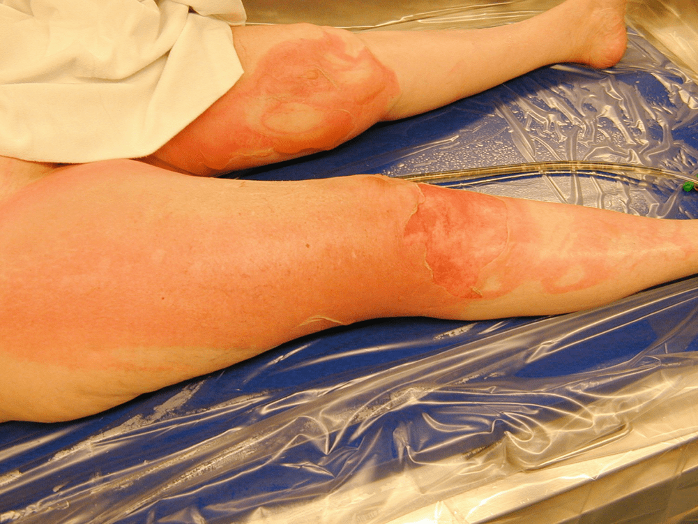 Management of the Burn Patient Plastic Surgery Key