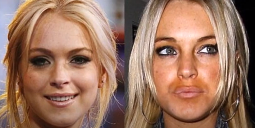 Lindsay Lohan Plastic Surgery how well did it go? Plastic Surgery