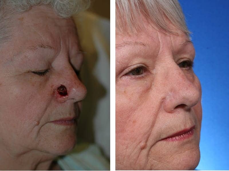 New Procedure Can Repair Skin Cancer on the Nose in One Step Plastic