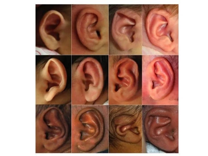 Nonsurgical Procedure Quickly and Effectively Corrects Newborn Ear Deformities Plastic Surgery