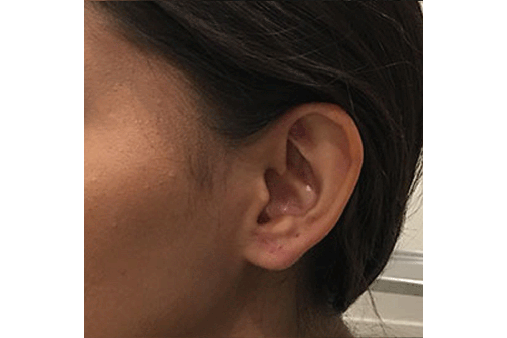 Earlobe Repair Dr. Dev Wali