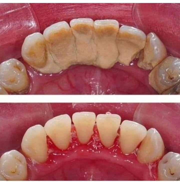 What Exactly Is Tartar? And How To Remove Tartar From Your Teeth