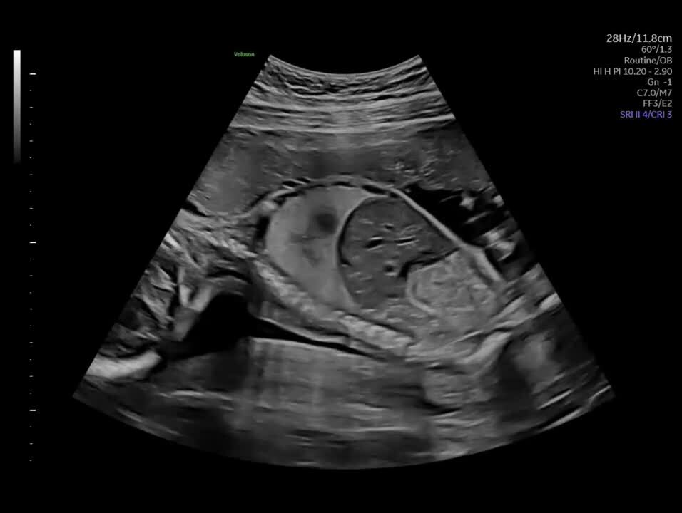 Voluson Expert 22 Imaging Capabilities GE HealthCare