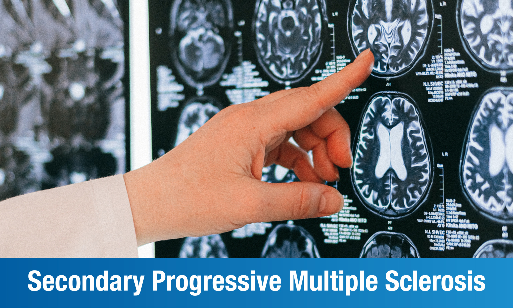 Secondary Progressive Multiple Sclerosis Causes, Symptoms & Treatment
