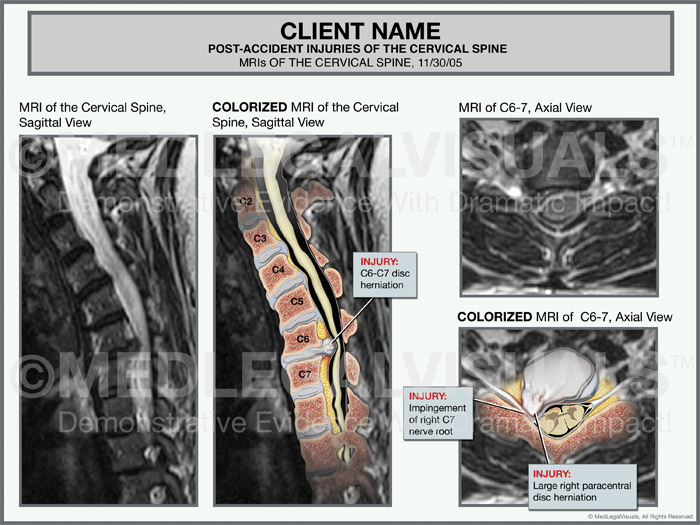Cervical Disc Herniation Premier Law Group