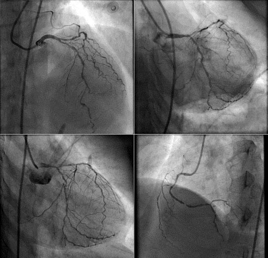 Coronary Angiogram Specialist in Bangalore, Chennai Angiogram Cost