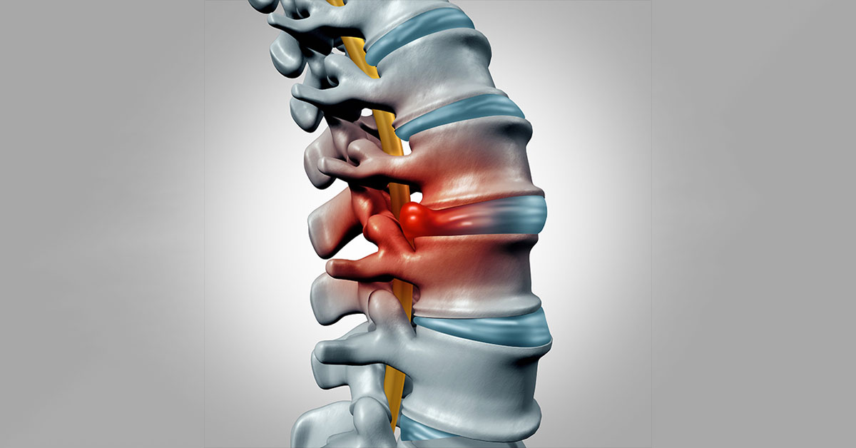 Cervical Myelopathy Scottsdale, AZ Orthopedic Spine Surgery